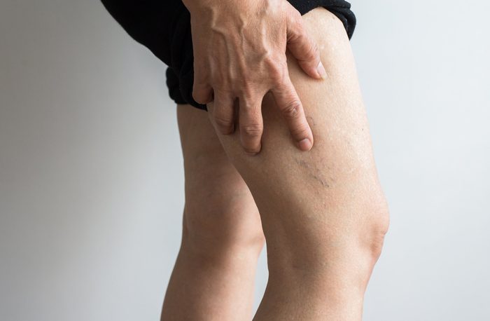 deep vein thrombosis | veins on elderly woman's leg