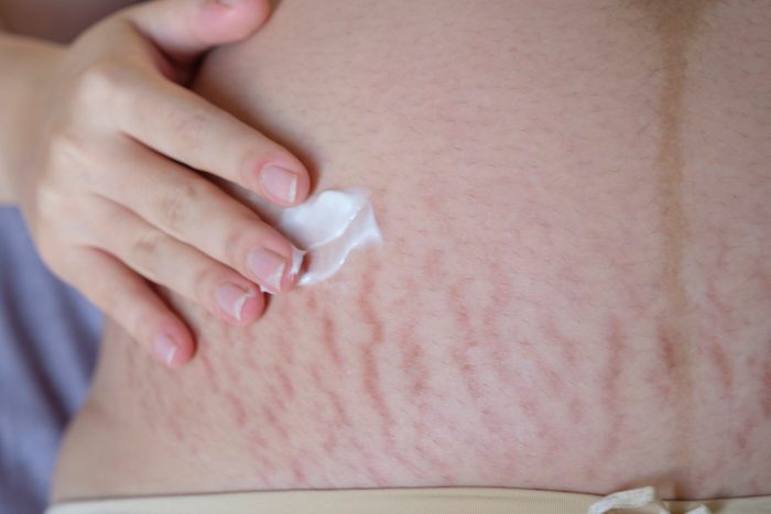 beauty products | woman applying cream to stretch marks