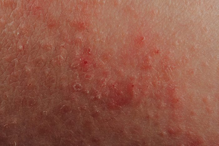 signs your body is in trouble | skin rash close up