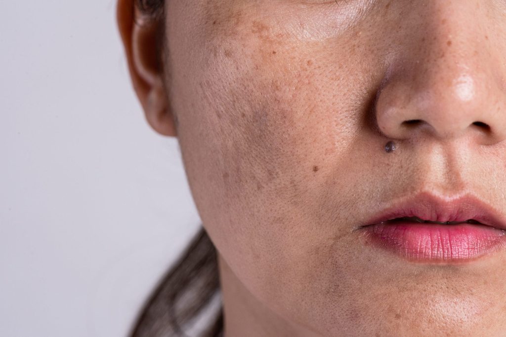hyperpigmentation | closeup of woman's skin | dark spots skin discolouration
