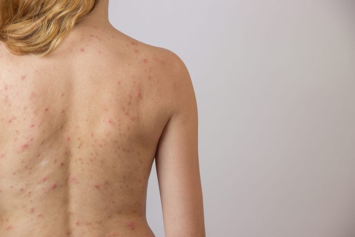 body acne | Young,girl,with,acne,,with,red,and,white,spots,on