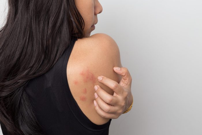 Woman Showing Her Skin Itching Behind With Allergy Rash Urticaria Symptoms