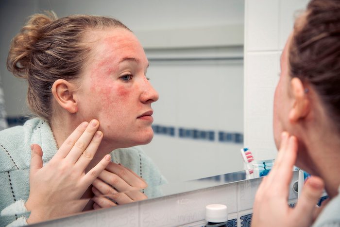 hives on face | woman looking in mirror at hives on face