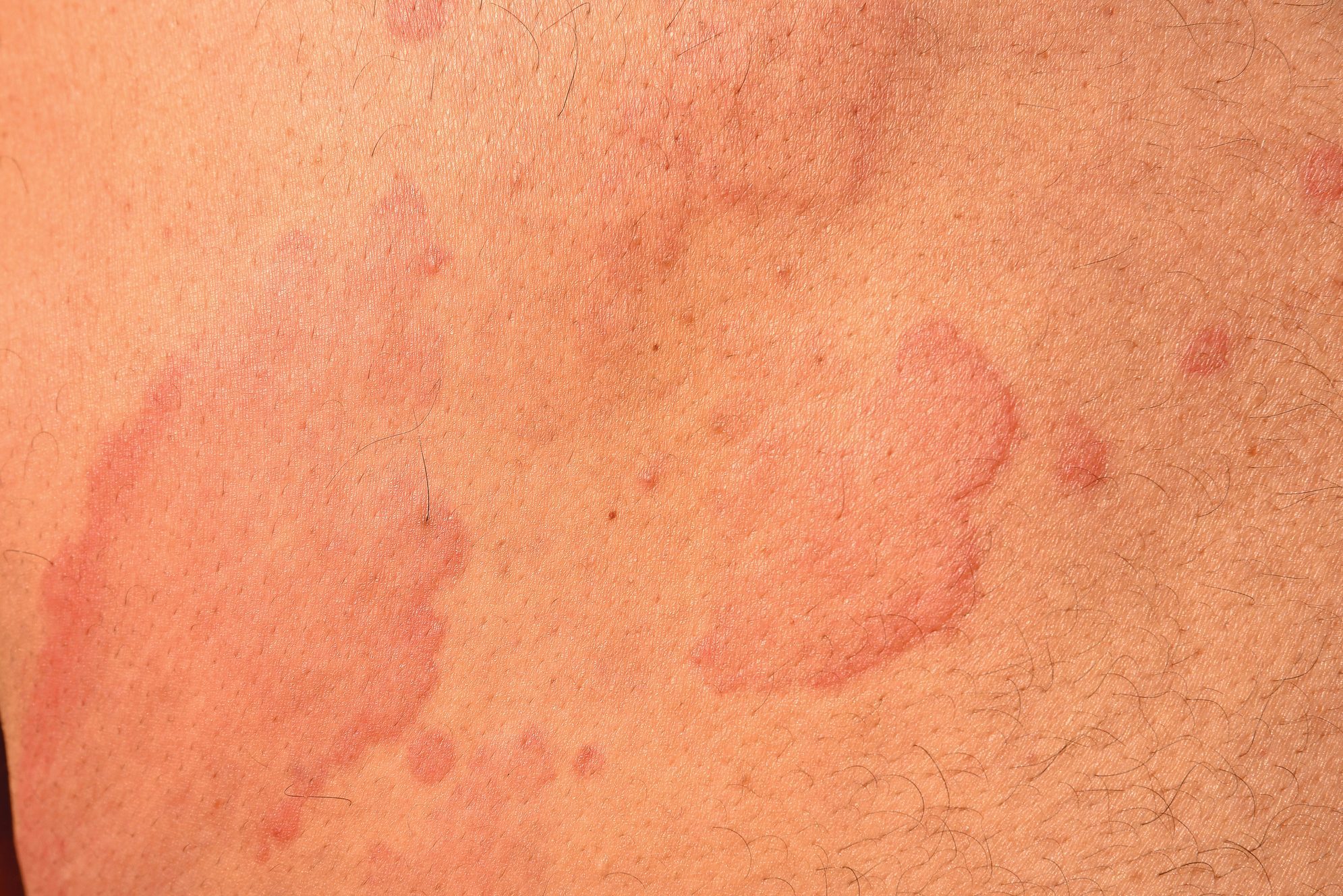 Hives Urticaria Skin Disease