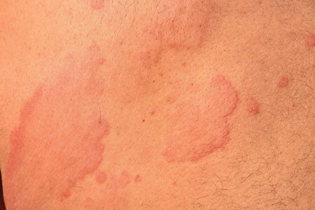 Hives Urticaria Skin Disease