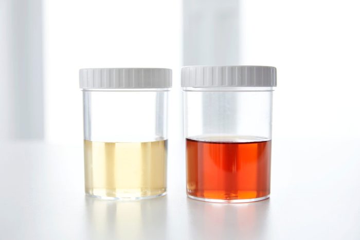 urine colour chart | Blood In Human Urine In Sample Pot