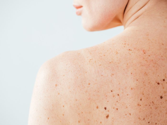 abcde skin cancer | Cropped,view,of,diseased,and,naked,woman,with,moles,on