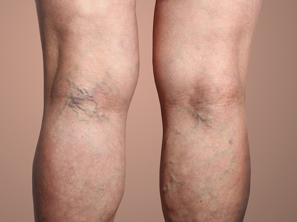 When to Worry About Varicose Veins Plus Treatment Options
