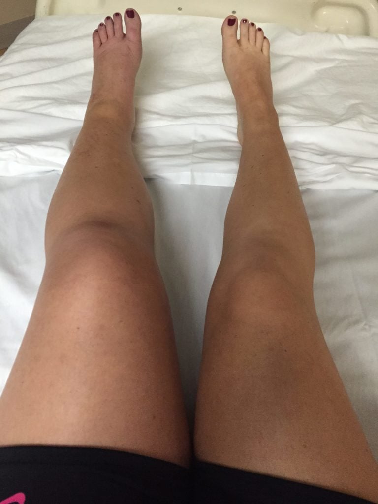 can amlodipine cause swollen legs