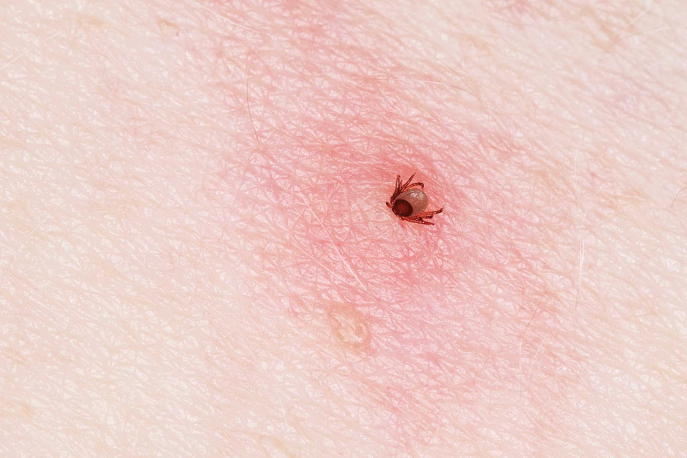 Identifying Bug Bites How To Figure Out What Bit You Best Health Canada